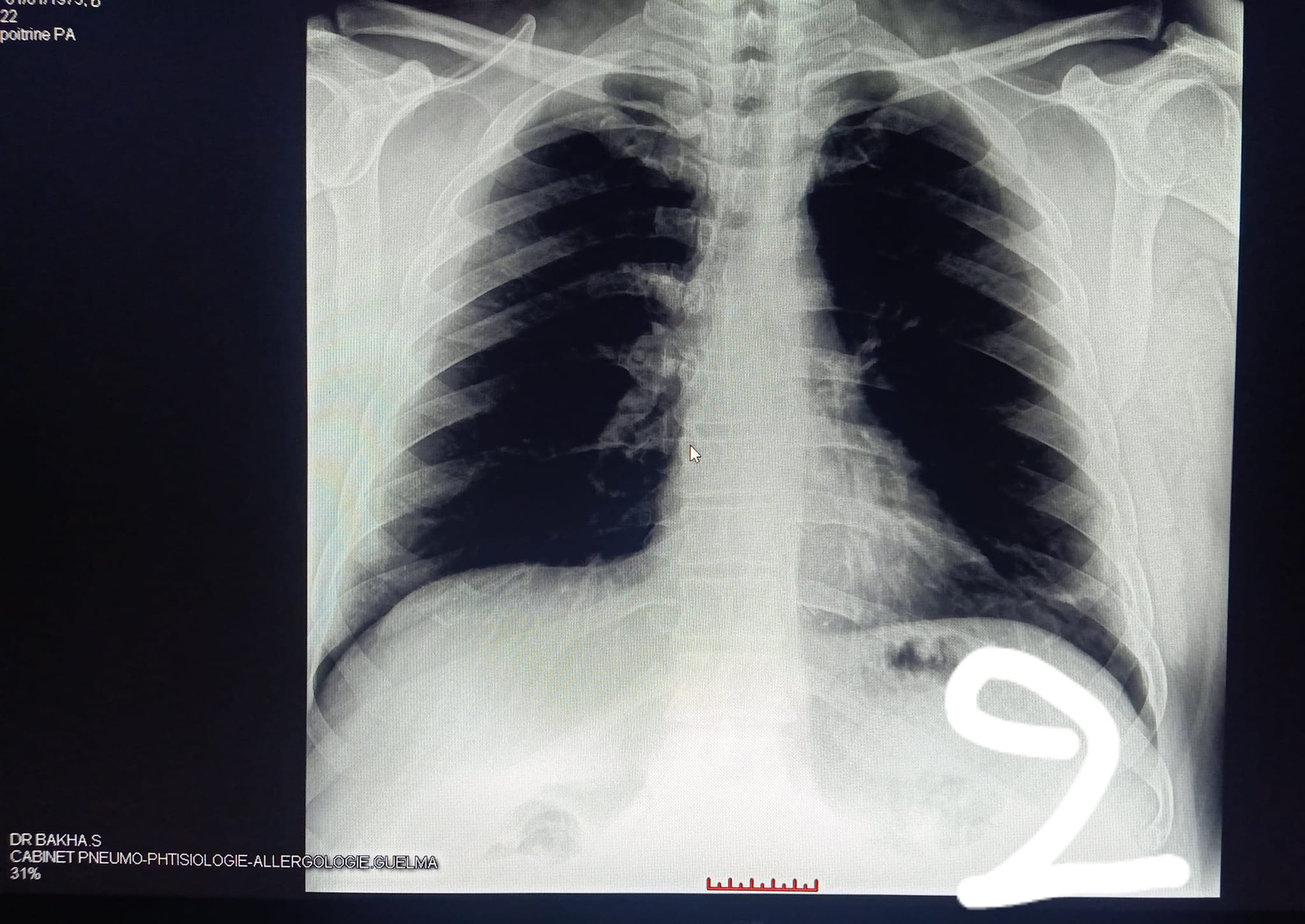 Traitement de l'asthme chez un enfant à Guelma